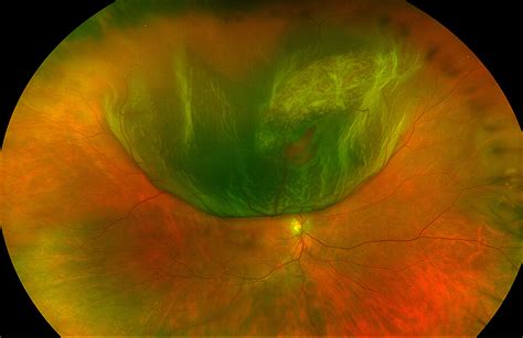 retinal tear detachment